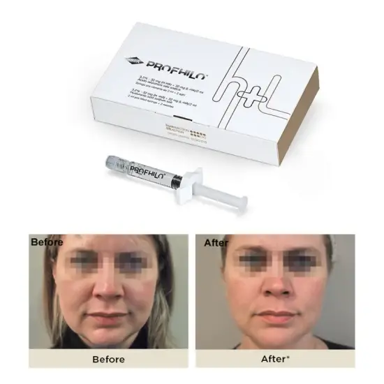 Profhilo Gel: Sự lựa chọn hàng đầu cho điểm nâng cơ mặt cổ với hàm lượng axit hyaluronic cao và ổn định hình ảnh 1-description